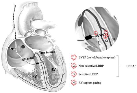 lvap course